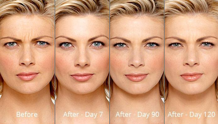 Botox Treatment: California Face Institute